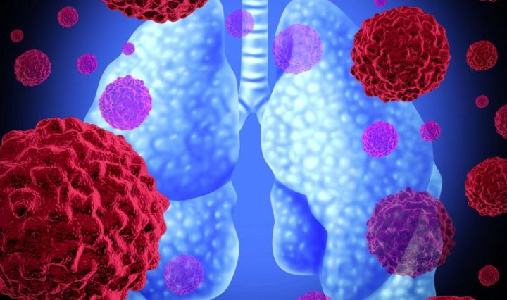 Una cifra sin precedentes del 60% de los pacientes permanecen vivos sin progresión de la enfermedad después de cinco años, con inhibidor de ALK de tercera generación1