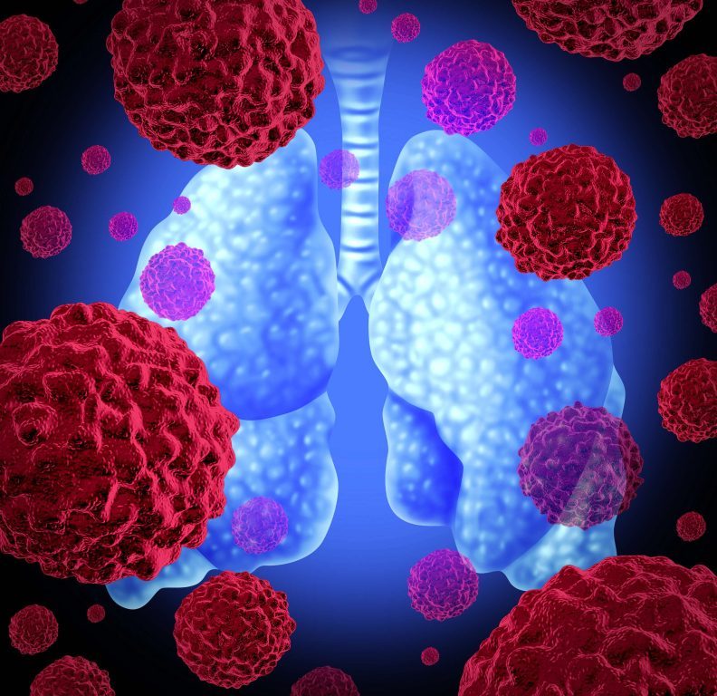 Una cifra sin precedentes del 60% de los pacientes permanecen vivos sin progresión de la enfermedad después de cinco años, con inhibidor de ALK de tercera generación1