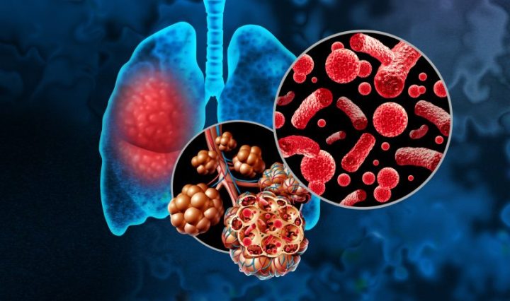 ¡Vacunarse es una herramienta de prevención!1 Neumococo y virus respiratorios elevan riesgo de padecer neumonía