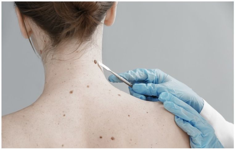 Día Mundial Contra el Cáncer de Piel MEGALABS UMBRELLA