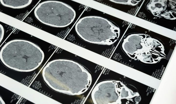 Investigadores de Mayo Clinic revelan un enfoque personalizado para el monitoreo del cáncer de cerebro