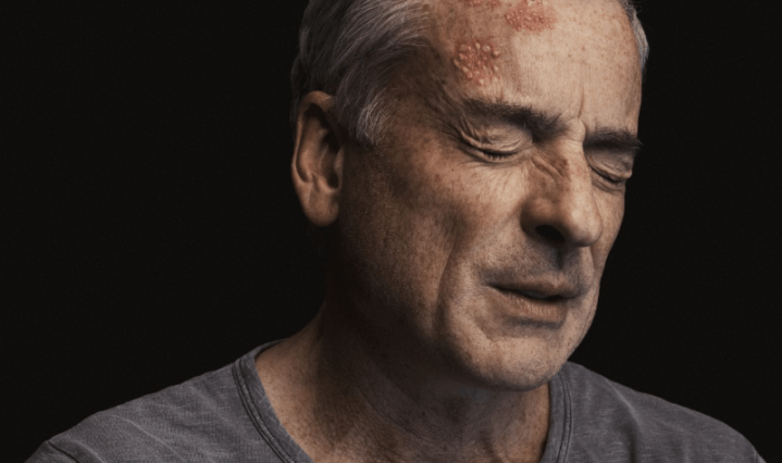 Los 7 mitos más comunes del Herpes Zóster