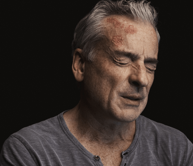 Los 7 mitos más comunes del Herpes Zóster