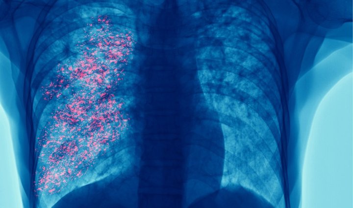 El cáncer de pulmón sigue siendo la principal causa de muerte por cáncer