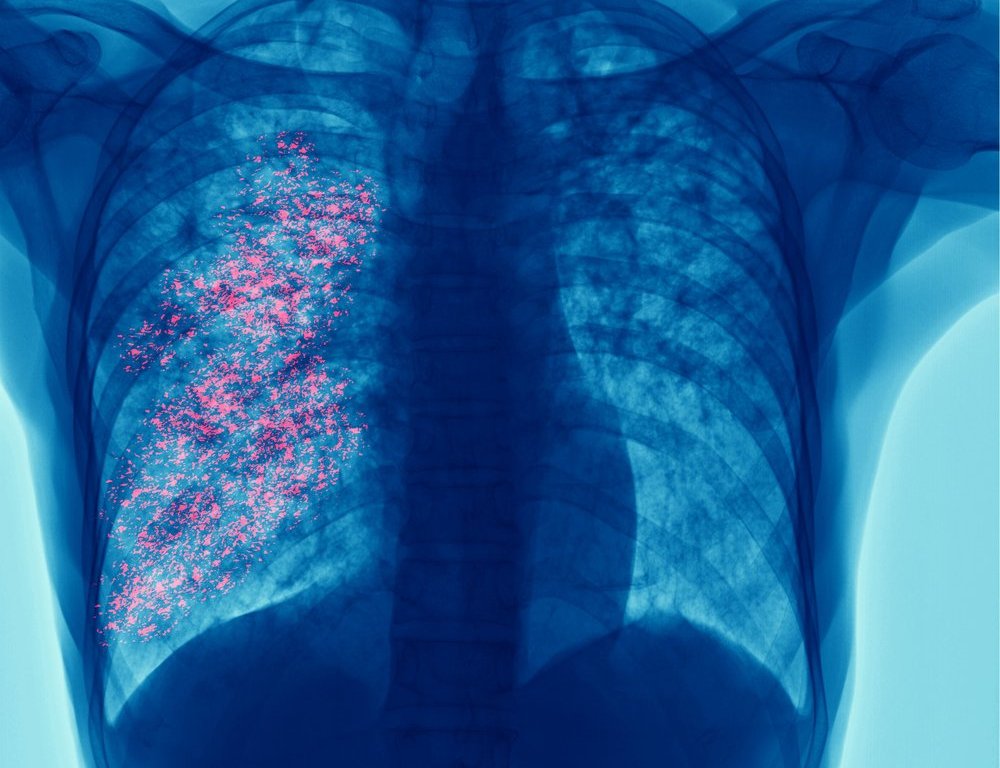 El cáncer de pulmón sigue siendo la principal causa de muerte por cáncer